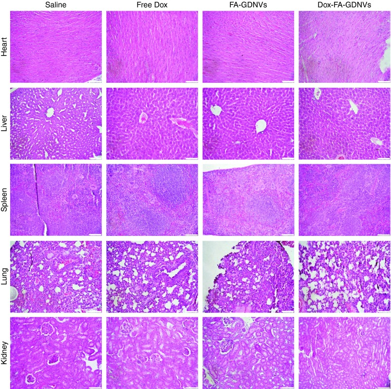 基于生姜衍生脂質納米載體（GDNVs）的阿霉素遞送系統：新型結腸癌治療策略