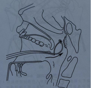 耳匙是什么不同手术方式切除腺样体，有什么区别？_https://www.jmylbn.com_新闻资讯_第8张