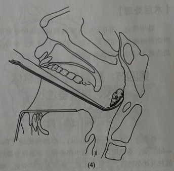 耳匙是什么不同手术方式切除腺样体，有什么区别？_https://www.jmylbn.com_新闻资讯_第9张
