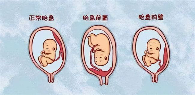 胎盘图片 前壁图片