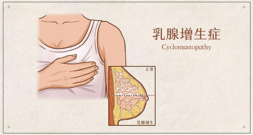 乳腺结节,增生,囊肿……这些包包有何不同?-友友