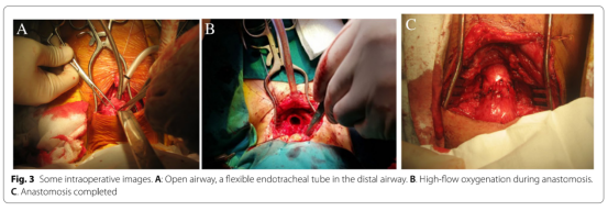 为什么用高流量呼吸【醉仁心胸】气管切除重建术中采用经鼻高流量氧气行呼吸暂停氧合_https://www.jmylbn.com_新闻资讯_第8张