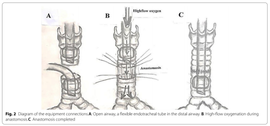 为什么用高流量呼吸【醉仁心胸】气管切除重建术中采用经鼻高流量氧气行呼吸暂停氧合_https://www.jmylbn.com_新闻资讯_第7张