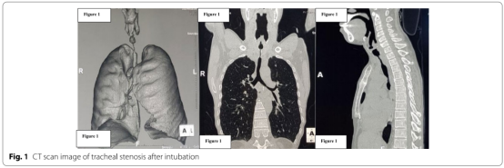 为什么用高流量呼吸【醉仁心胸】气管切除重建术中采用经鼻高流量氧气行呼吸暂停氧合_https://www.jmylbn.com_新闻资讯_第6张