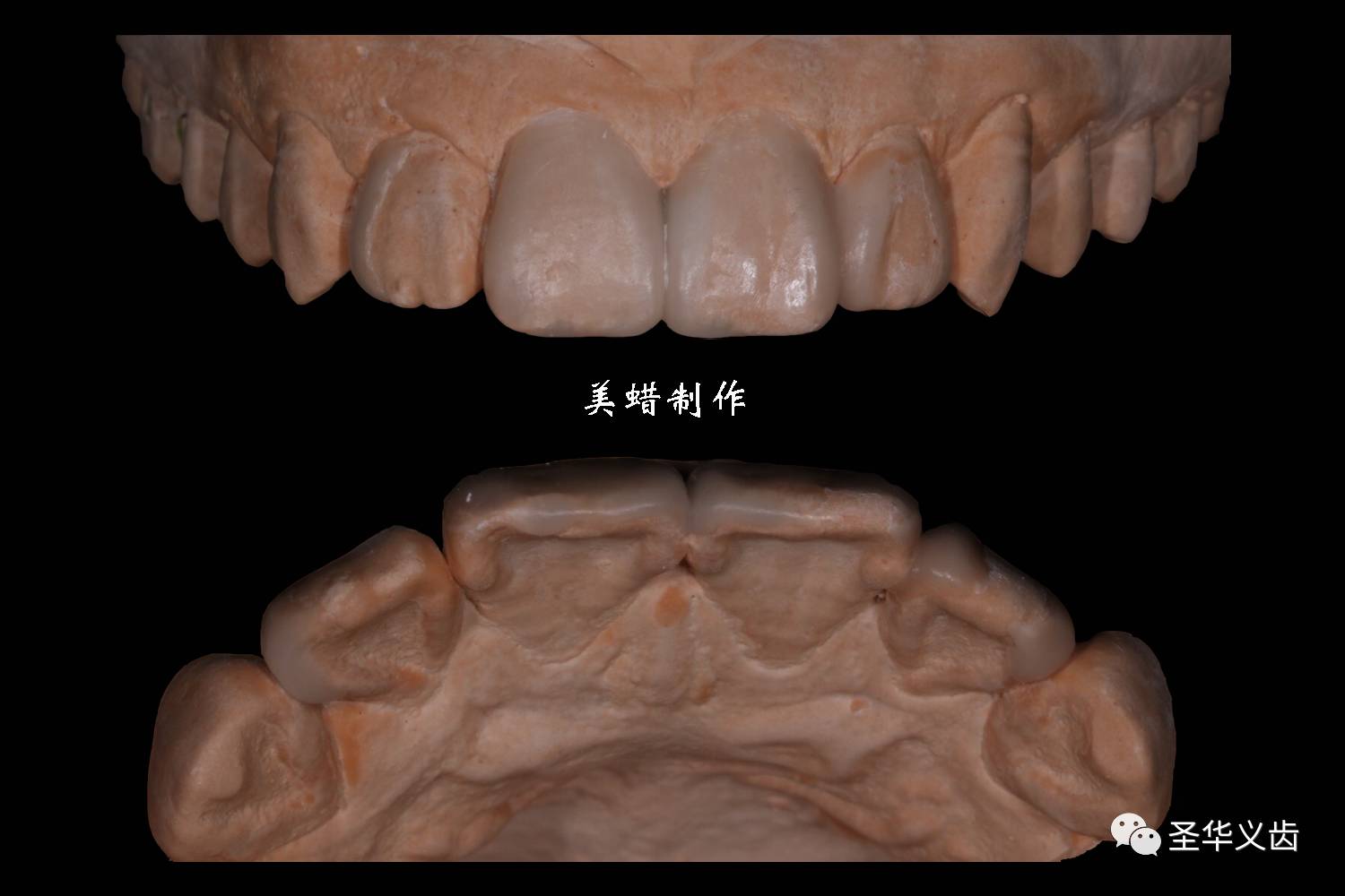 阮宗芳口腔门诊—圣华义齿星钻美学团队开年首场技术支持!