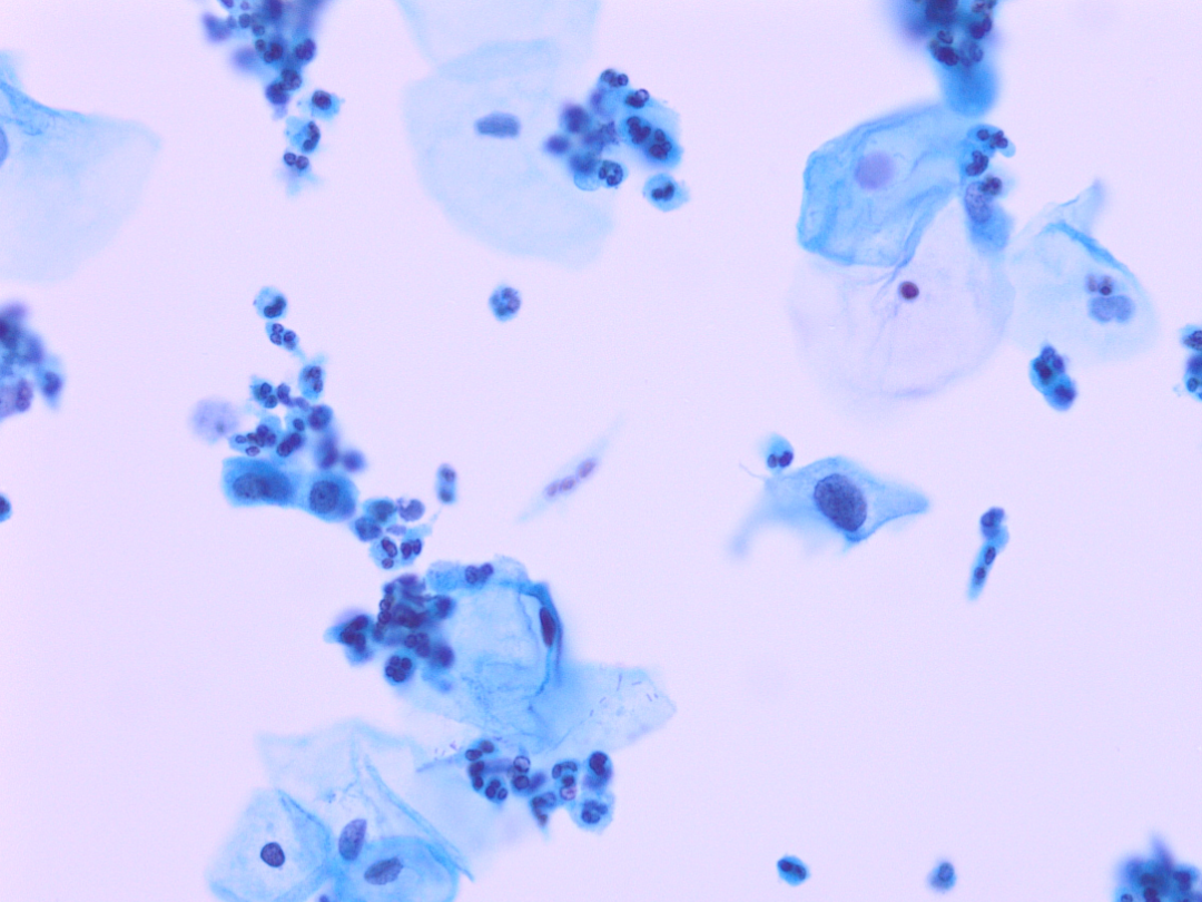 lct怎么检查【医学科普】宫颈液基细胞学（TCT／LCT）检查报告不会看？一图教会你读懂_https://www.jmylbn.com_新闻资讯_第12张