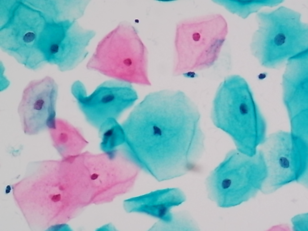 lct怎么检查【医学科普】宫颈液基细胞学（TCT／LCT）检查报告不会看？一图教会你读懂_https://www.jmylbn.com_新闻资讯_第10张