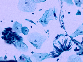 lct怎么检查【医学科普】宫颈液基细胞学（TCT／LCT）检查报告不会看？一图教会你读懂_https://www.jmylbn.com_新闻资讯_第24张