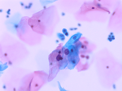 lct怎么检查【医学科普】宫颈液基细胞学（TCT／LCT）检查报告不会看？一图教会你读懂_https://www.jmylbn.com_新闻资讯_第18张