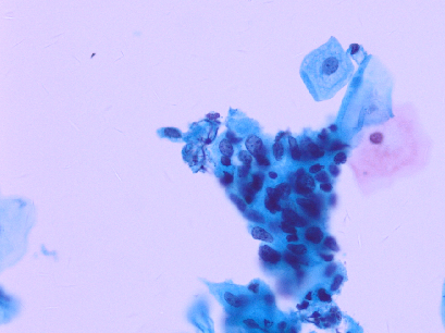 lct怎么检查【医学科普】宫颈液基细胞学（TCT／LCT）检查报告不会看？一图教会你读懂_https://www.jmylbn.com_新闻资讯_第20张