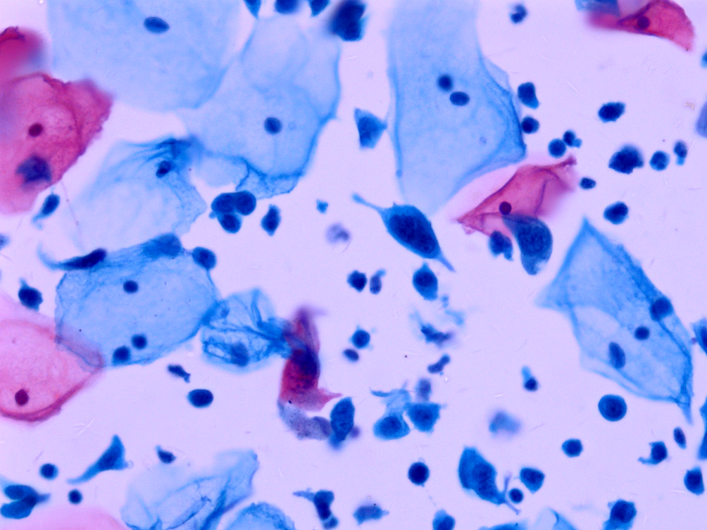 lct怎么检查【医学科普】宫颈液基细胞学（TCT／LCT）检查报告不会看？一图教会你读懂_https://www.jmylbn.com_新闻资讯_第22张