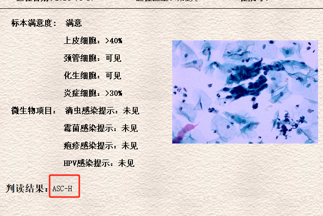 lct怎么检查【医学科普】宫颈液基细胞学（TCT／LCT）检查报告不会看？一图教会你读懂_https://www.jmylbn.com_新闻资讯_第5张