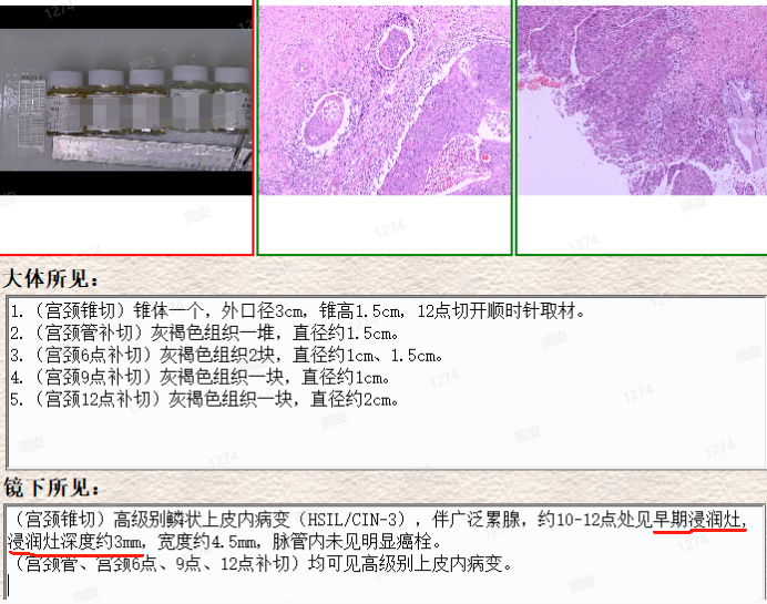 lct怎么检查【医学科普】宫颈液基细胞学（TCT／LCT）检查报告不会看？一图教会你读懂_https://www.jmylbn.com_新闻资讯_第6张