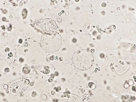 上皮细胞用什么染色尿液发现大量空泡，到底是什么？_https://www.jmylbn.com_新闻资讯_第2张