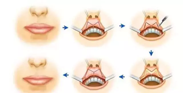 m形切口的厚唇改薄手术后要求72小时内多做冰敷,需要一天两次在局部