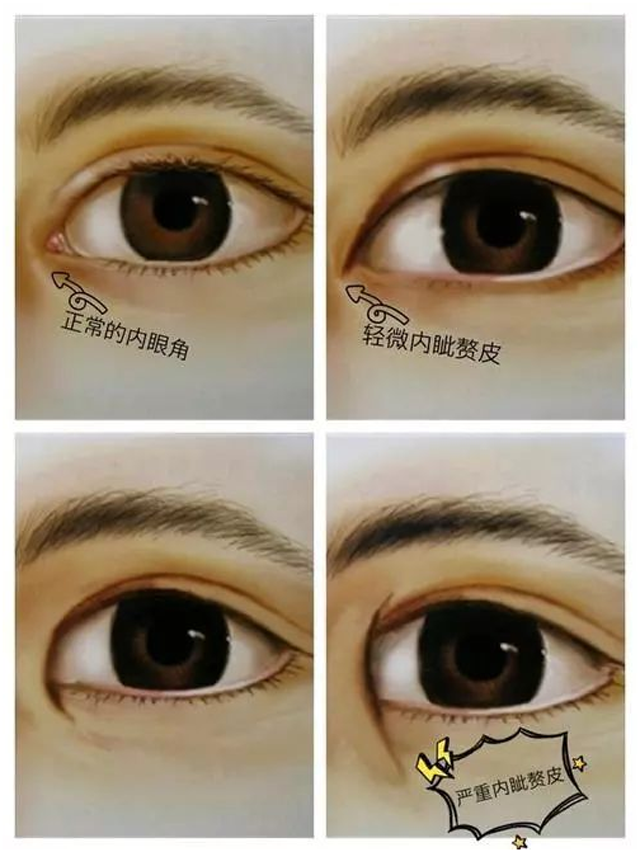 开眼角通过去除内眦赘皮,延长眼裂水平长度(也就是