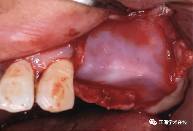 什么是口腔修复膜海奥口腔修复膜S1型重磅上市_https://www.jmylbn.com_新闻资讯_第9张