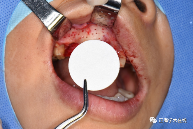 什么是口腔修复膜海奥口腔修复膜S1型重磅上市_https://www.jmylbn.com_新闻资讯_第8张