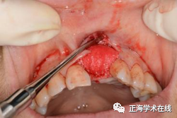 什么是口腔修复膜海奥口腔修复膜S1型重磅上市_https://www.jmylbn.com_新闻资讯_第10张