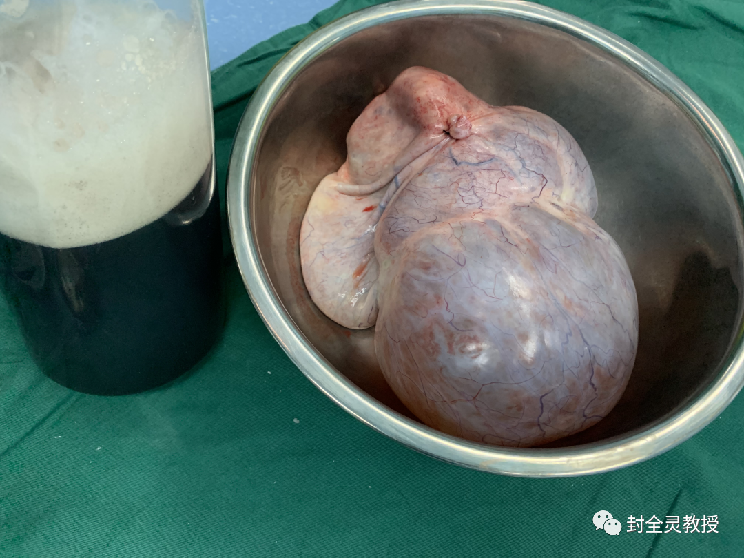 卵巢畸胎瘤100个人中有几个_卵巢畸胎瘤中期可以治愈率_卵巢畸胎瘤1cm