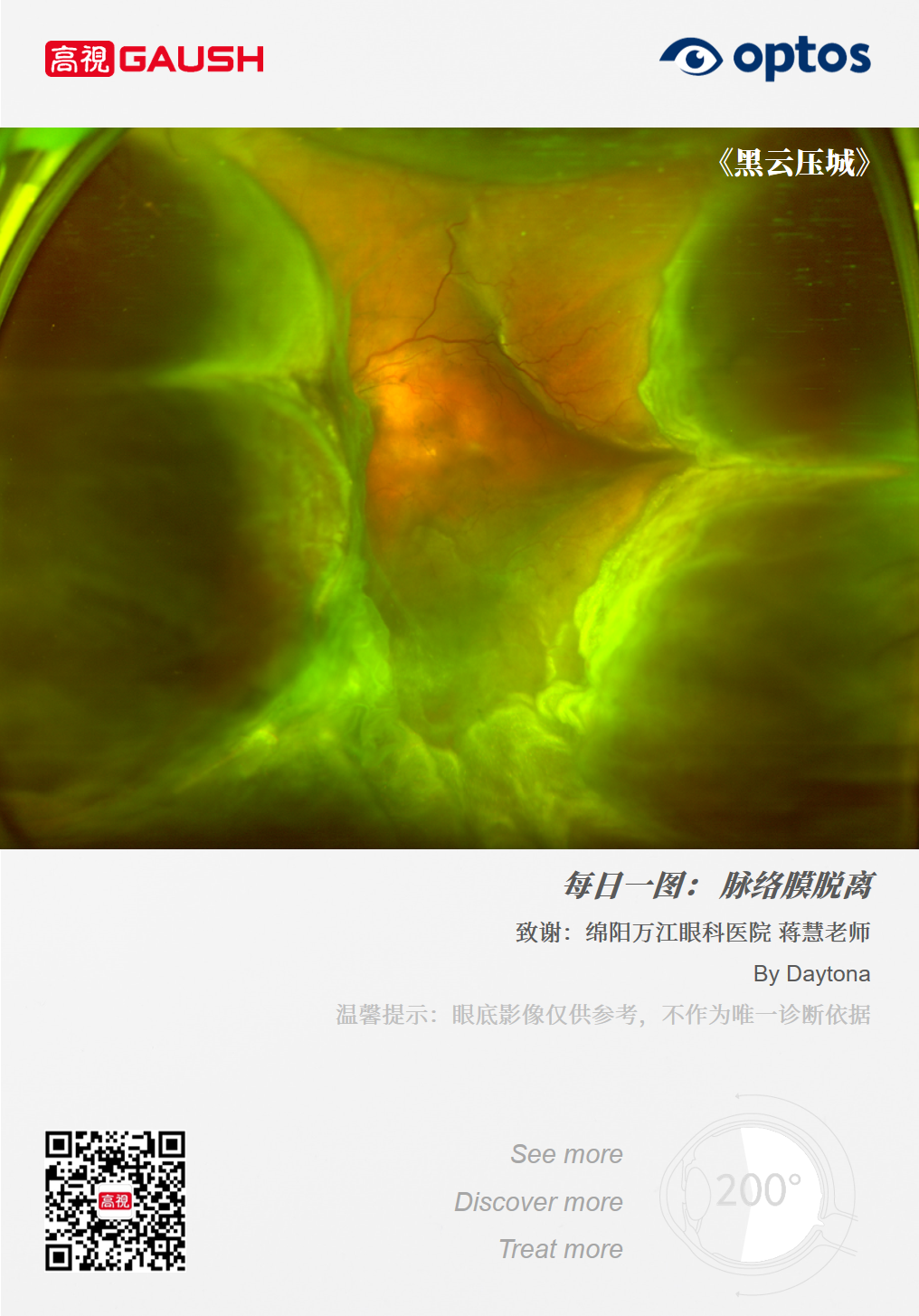 脉络膜脱离型视网膜脱离 _ 中国眼科基因治疗临床研究伦理审查专家共识 – DXBZ