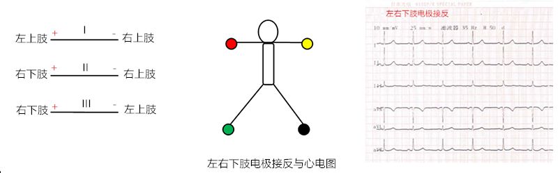 心电图怎么切换导联【干货】肢体导联电极错接的心电图分析及鉴别（上）：四夹子导联_https://www.jmylbn.com_新闻资讯_第7张