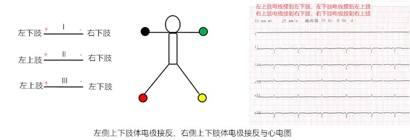 心电图怎么切换导联临床找茬系列｜错接心电图表现_https://www.jmylbn.com_新闻资讯_第10张