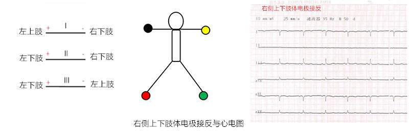 心电图怎么切换导联临床找茬系列｜错接心电图表现_https://www.jmylbn.com_新闻资讯_第9张