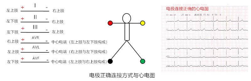 心电图怎么切换导联临床找茬系列｜错接心电图表现_https://www.jmylbn.com_新闻资讯_第7张