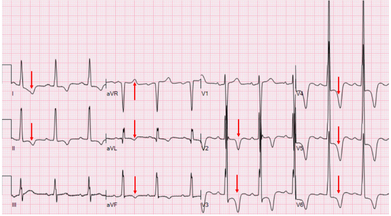 注:心尖部肥厚型心肌病患者的心电图,窦性心律,左室高电压,avr导联t波