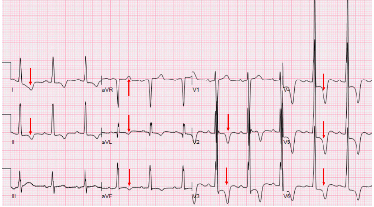 左室高电压,avr导联t波直立,i,ii,avl,avf导联t波置,v3-v6导联st段