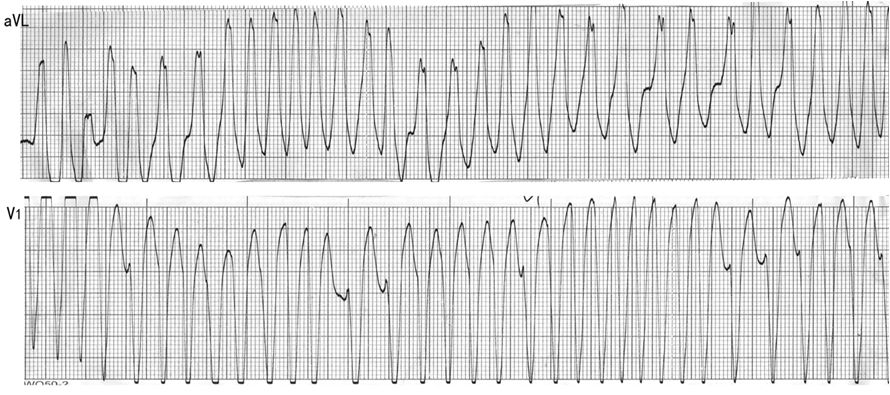 图6. 恶性房颤心电图,下图中房颤蜕变为室颤.