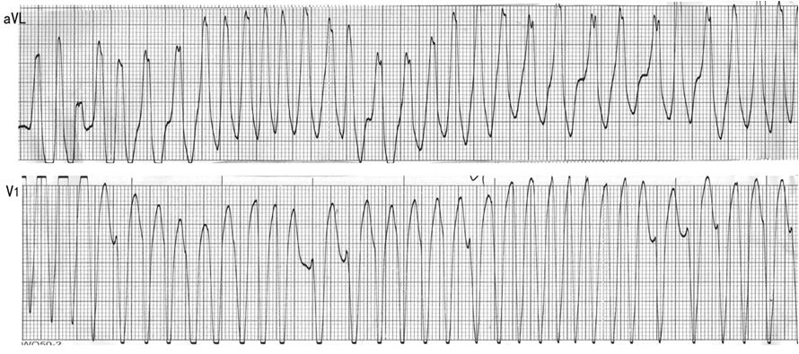 图6 恶性房颤心电图,下图中房颤蜕变为室颤.