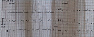 心电图怎么切换导联临床找茬系列｜错接心电图表现_https://www.jmylbn.com_新闻资讯_第20张