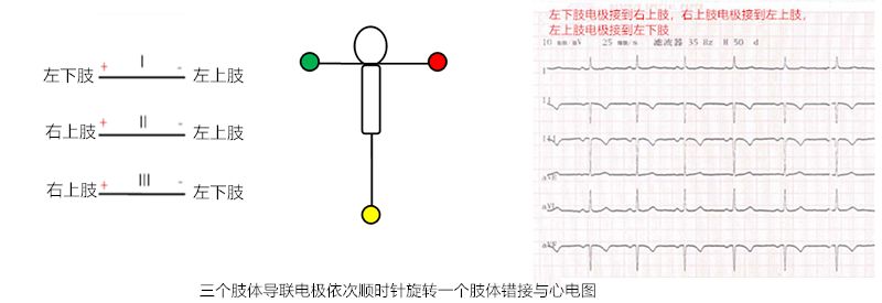 心电图怎么切换导联临床找茬系列｜错接心电图表现_https://www.jmylbn.com_新闻资讯_第19张