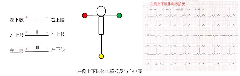心电图怎么切换导联临床找茬系列｜错接心电图表现_https://www.jmylbn.com_新闻资讯_第16张