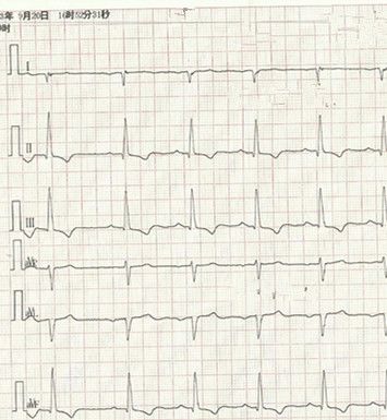 心电图怎么切换导联临床找茬系列｜错接心电图表现_https://www.jmylbn.com_新闻资讯_第12张