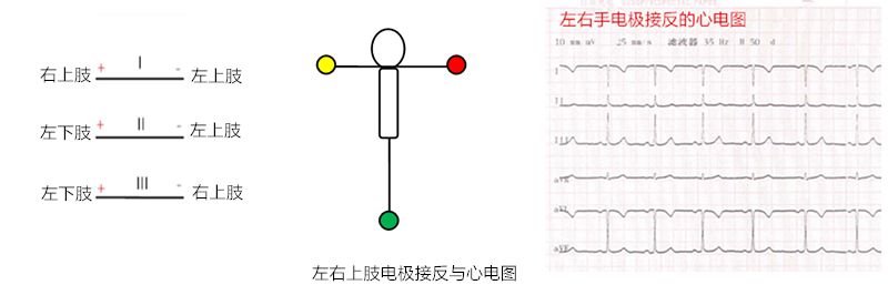 心电图怎么切换导联临床找茬系列｜错接心电图表现_https://www.jmylbn.com_新闻资讯_第11张