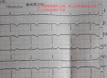 心电图怎么切换导联临床找茬系列｜错接心电图表现_https://www.jmylbn.com_新闻资讯_第22张