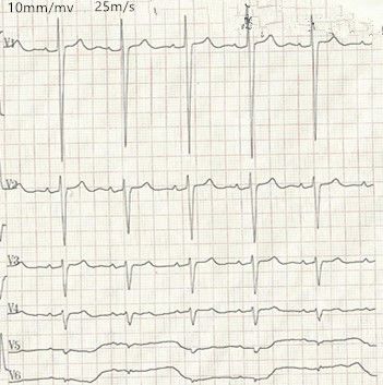 心电图怎么切换导联临床找茬系列｜错接心电图表现_https://www.jmylbn.com_新闻资讯_第13张