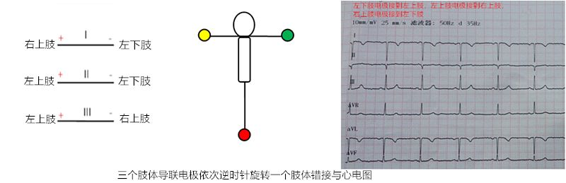 心电图怎么切换导联临床找茬系列｜错接心电图表现_https://www.jmylbn.com_新闻资讯_第18张