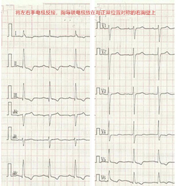 心电图怎么切换导联临床找茬系列｜错接心电图表现_https://www.jmylbn.com_新闻资讯_第15张