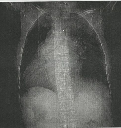 心电图怎么切换导联临床找茬系列｜错接心电图表现_https://www.jmylbn.com_新闻资讯_第14张