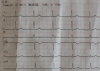 心电图怎么切换导联临床找茬系列｜错接心电图表现_https://www.jmylbn.com_新闻资讯_第21张