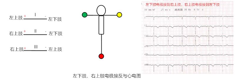 心电图怎么切换导联临床找茬系列｜错接心电图表现_https://www.jmylbn.com_新闻资讯_第17张