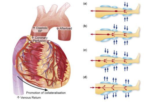 图1. 体外反搏示意图.