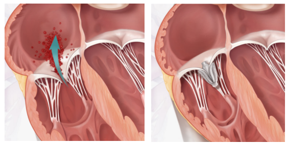 acc 2022|宋光远教授:clasp tr研究——三尖瓣反流经导管介入治疗一年