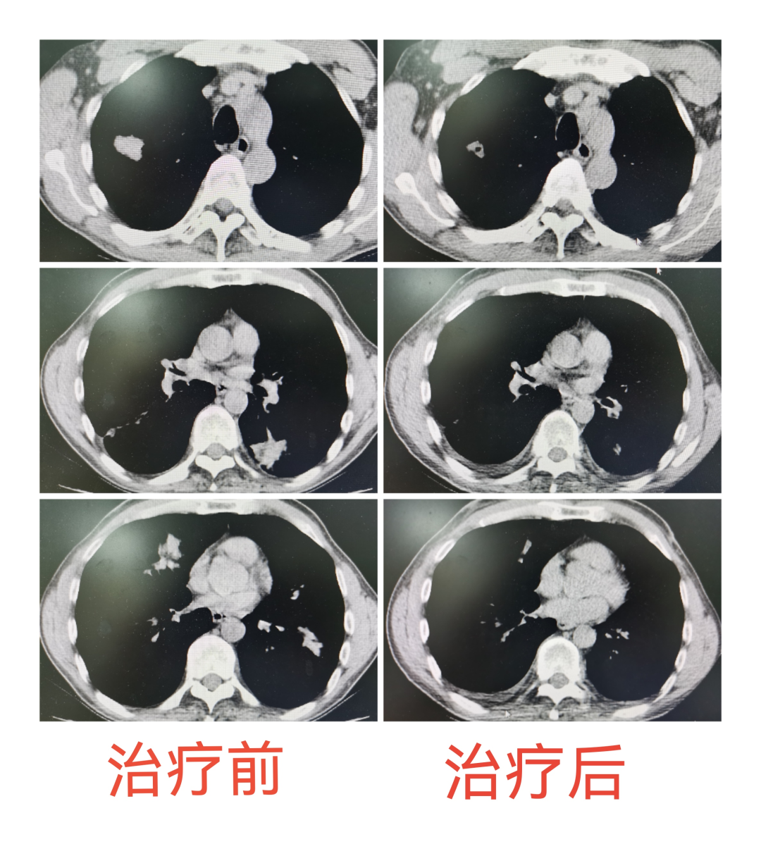 abp在医学是什么意思全省首例 ｜ 宝高医确诊一例“嗜酸性肉芽肿多血管炎（EGPA）合并变应性支气管肺曲霉菌病（ABPA）”病例_https://www.jmylbn.com_新闻资讯_第3张