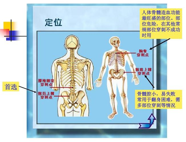 什么是骨髓针科普-关于骨髓穿刺你应该了解的那些事_https://www.jmylbn.com_新闻资讯_第11张