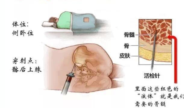 什么是骨髓针科普-关于骨髓穿刺你应该了解的那些事_https://www.jmylbn.com_新闻资讯_第16张